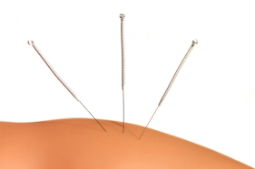 Acupuncture